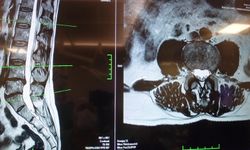 “Her Bel Ağrısı Fıtık Değil” Uyarısı! Uzmanından Kritik Açıklama